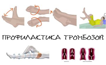 Тромбоз: невидимая угроза и как от неё защититься